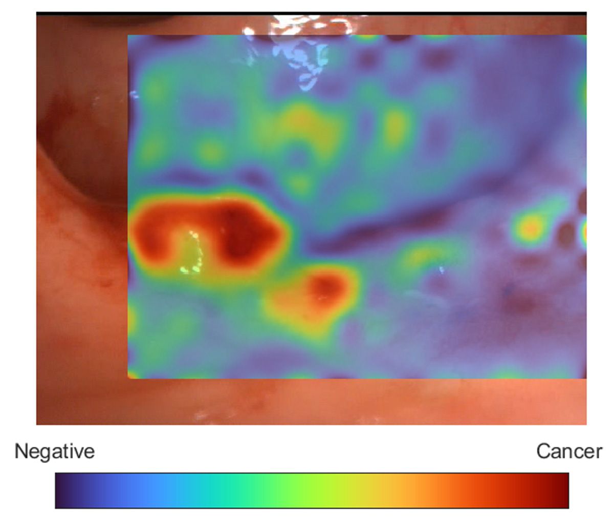 A colon polyp image is shown with a color-coded overlay indicating the AI-predicted probability a region is cancerous or noncancerous.