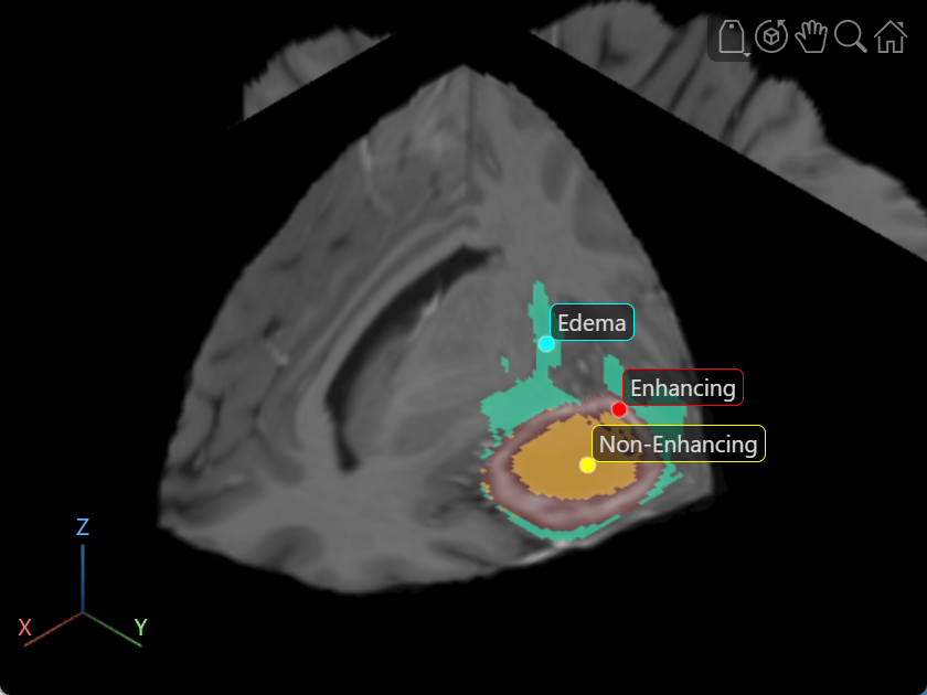 Zoomed in display showing the tumor subregions with custom text labels