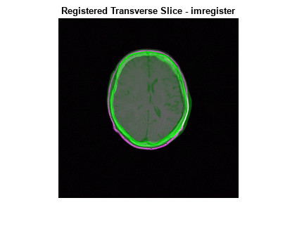 Figure contains an axes object. The axes object with title Registered Transverse Slice - imregister contains an object of type image.