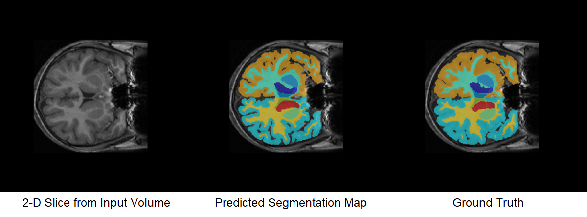 PDF] Brain Tumor Segmentation of MRI Images Using Processed Image Driven  U-Net Architecture