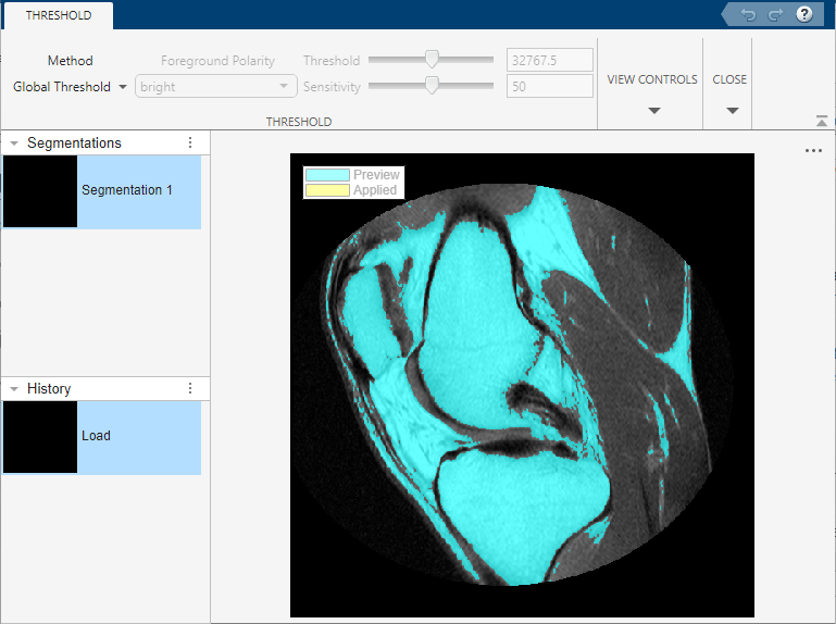 Preview of segmented knee using global thresholding.