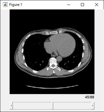 The Slice Viewer window displaying the middle slice of a CT scan with a slider to navigate slices